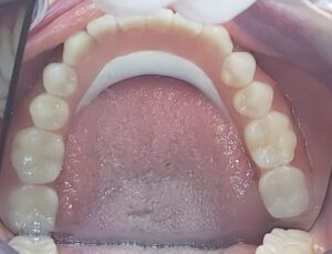 Zahnarzt implantate Bielefeld