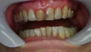 Veneers Bielefeld