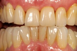 Veneers Bielefeld